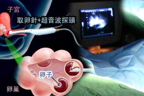 北京助孕花费多少钱,卵巢组织冻存北京妇产医院与北京儿童医院合作为EB病毒感